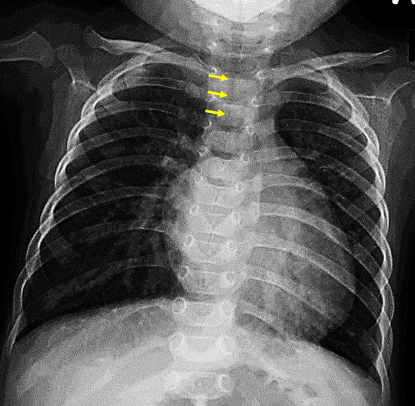 Pediatric Cardiology and Cardiac Surgery 37(2) 7887 (2021)