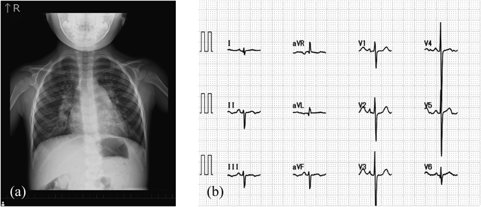 Pediatric Cardiology and Cardiac Surgery 31(4): 212-219 (2015)