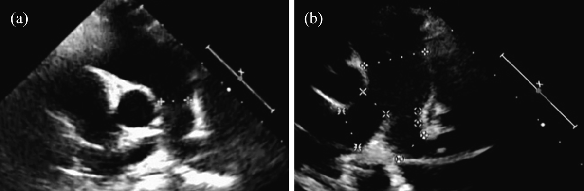 Pediatric Cardiology and Cardiac Surgery 31(4): 212-219 (2015)
