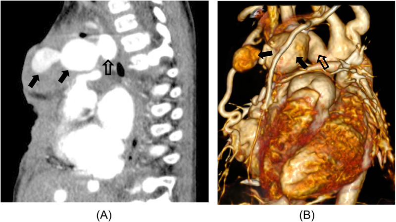 Pediatric Cardiology and Cardiac Surgery 31(5): 271-277 (2015)