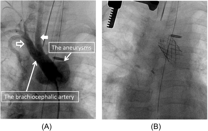 Pediatric Cardiology and Cardiac Surgery 31(5): 271-277 (2015)