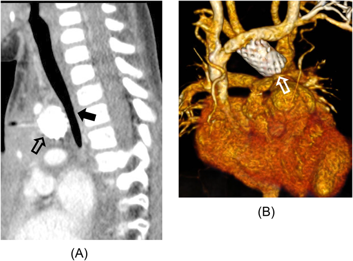Pediatric Cardiology and Cardiac Surgery 31(5): 271-277 (2015)