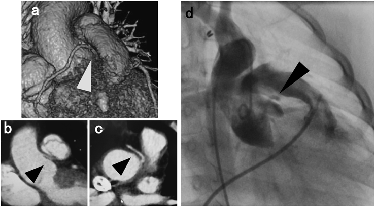 Pediatric Cardiology and Cardiac Surgery 31(6): 301-308 (2015)