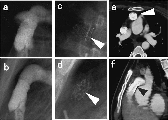 Pediatric Cardiology and Cardiac Surgery 31(6): 301-308 (2015)