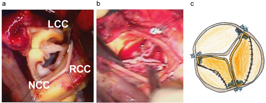 Pediatric Cardiology and Cardiac Surgery 31(6): 329-337 (2015)