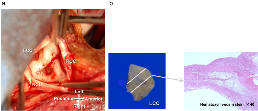 Pediatric Cardiology and Cardiac Surgery 31(6): 329-337 (2015)