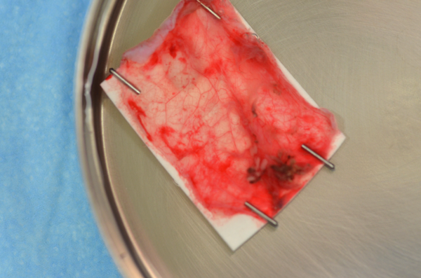 Pediatric Cardiology and Cardiac Surgery 31(6): 338-339 (2015)