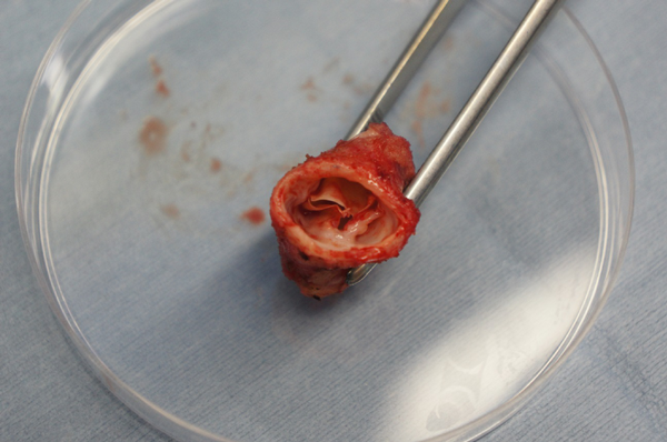 Pediatric Cardiology and Cardiac Surgery 31(6): 340-344 (2015)