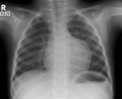 Pediatric Cardiology and Cardiac Surgery 31(6): 347-351 (2015)