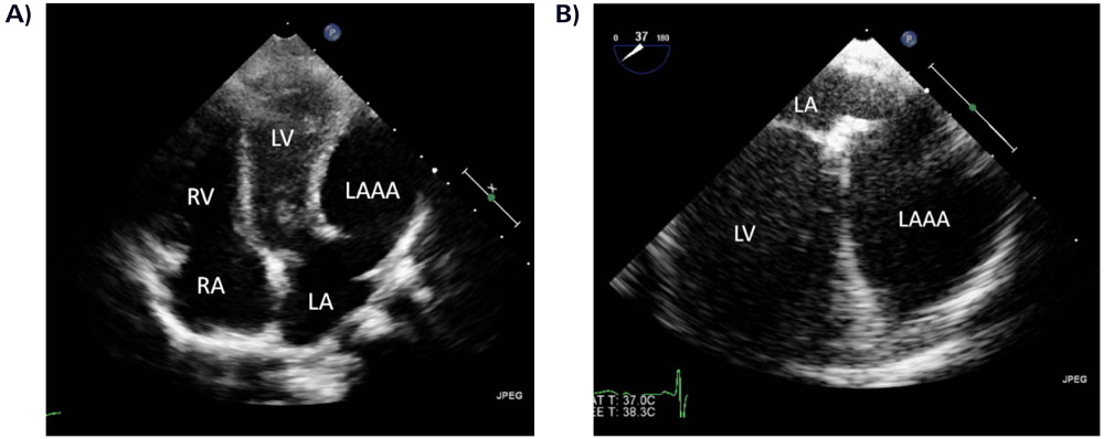 Pediatric Cardiology and Cardiac Surgery 31(6): 347-351 (2015)