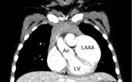 Pediatric Cardiology and Cardiac Surgery 31(6): 347-351 (2015)
