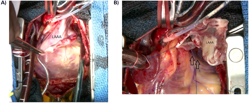 Pediatric Cardiology and Cardiac Surgery 31(6): 347-351 (2015)