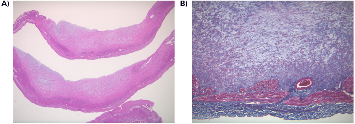 Pediatric Cardiology and Cardiac Surgery 31(6): 347-351 (2015)
