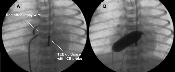 Pediatric Cardiology and Cardiac Surgery 31(1-2): 9-19 (2015)