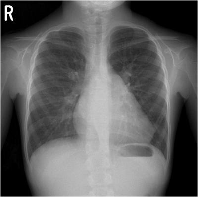 Pediatric Cardiology and Cardiac Surgery 32(2): 181-186 (2016)