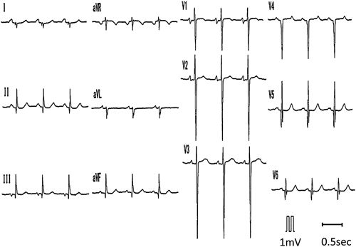 Pediatric Cardiology and Cardiac Surgery 32(2): 181-186 (2016)
