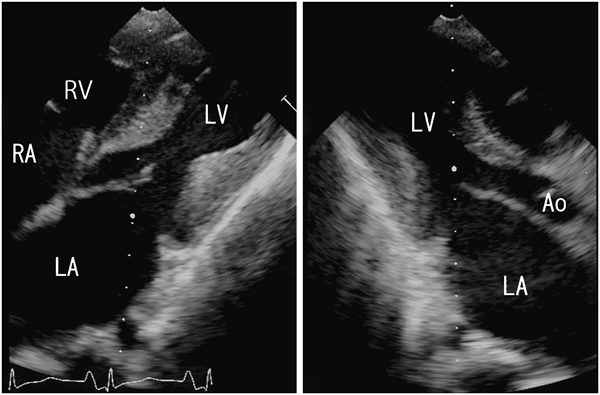 Pediatric Cardiology and Cardiac Surgery 32(2): 181-186 (2016)