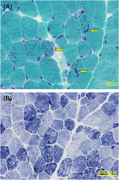 Pediatric Cardiology and Cardiac Surgery 32(2): 181-186 (2016)