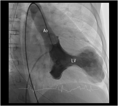 Pediatric Cardiology and Cardiac Surgery 32(2): 181-186 (2016)