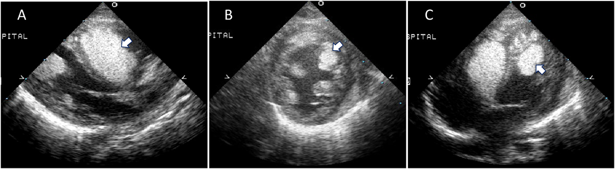 Pediatric Cardiology and Cardiac Surgery 32(3): 251-256 (2016)
