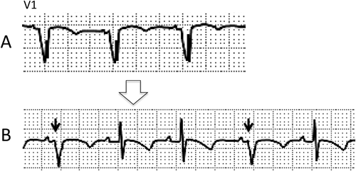 Pediatric Cardiology and Cardiac Surgery 32(3): 251-256 (2016)