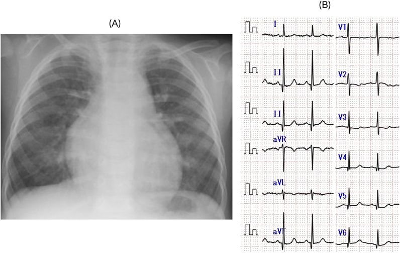 Pediatric Cardiology and Cardiac Surgery 32(6): 518-523 (2016)