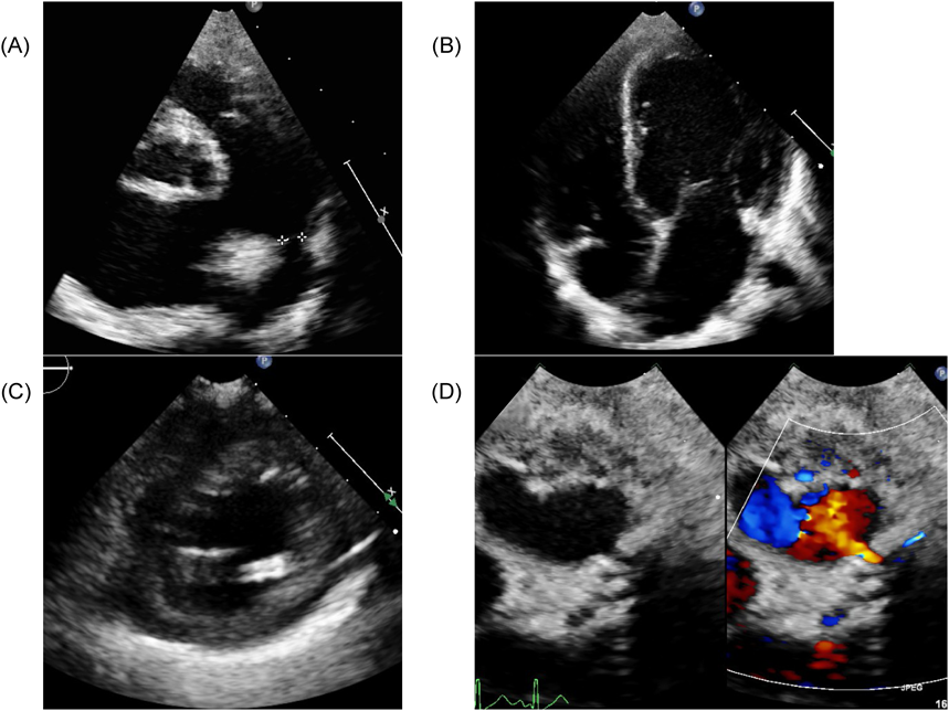 Pediatric Cardiology and Cardiac Surgery 32(6): 518-523 (2016)