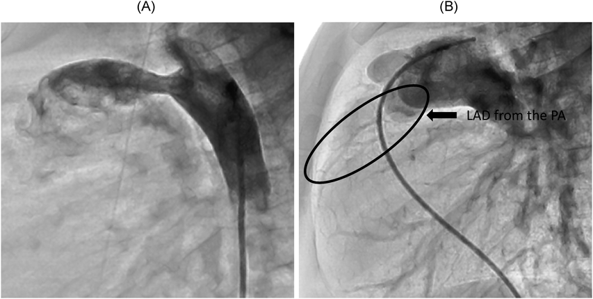 Pediatric Cardiology and Cardiac Surgery 32(6): 518-523 (2016)