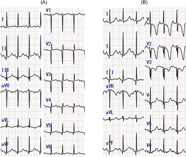 Pediatric Cardiology and Cardiac Surgery 32(6): 518-523 (2016)