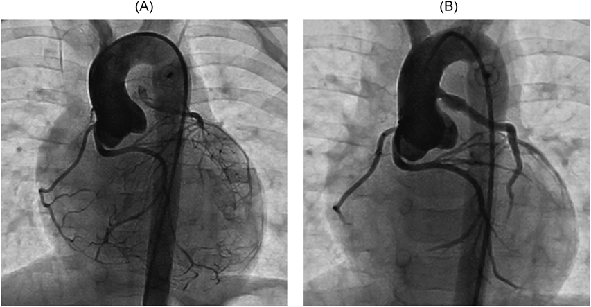 Pediatric Cardiology and Cardiac Surgery 32(6): 518-523 (2016)