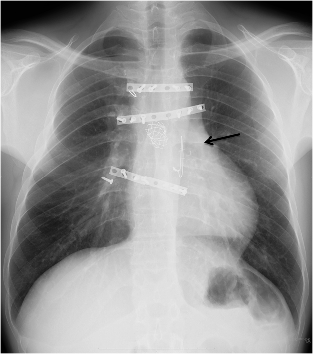 Pediatric Cardiology and Cardiac Surgery 32(6): 527-533 (2016)