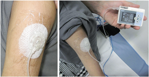 Pediatric Cardiology and Cardiac Surgery 33(3): 234-238 (2017)