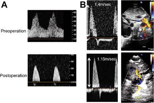 Pediatric Cardiology and Cardiac Surgery 33(4): 269-280 (2017)