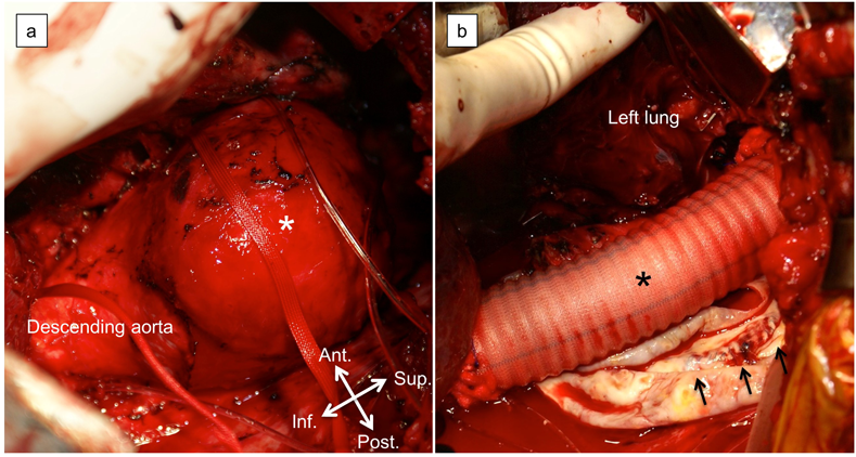 Pediatric Cardiology and Cardiac Surgery 33(5): 404-408 (2017)