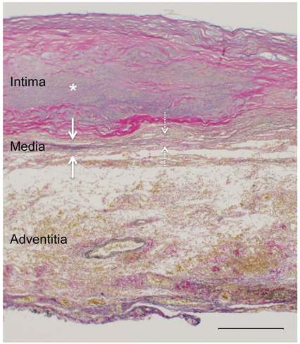 Pediatric Cardiology and Cardiac Surgery 33(5): 404-408 (2017)