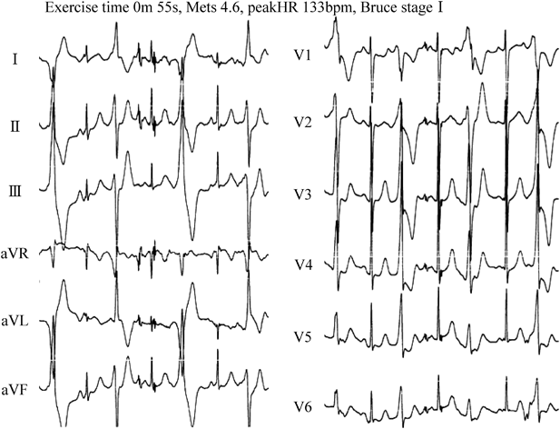 Pediatric Cardiology and Cardiac Surgery 33(1): 61-65 (2017)