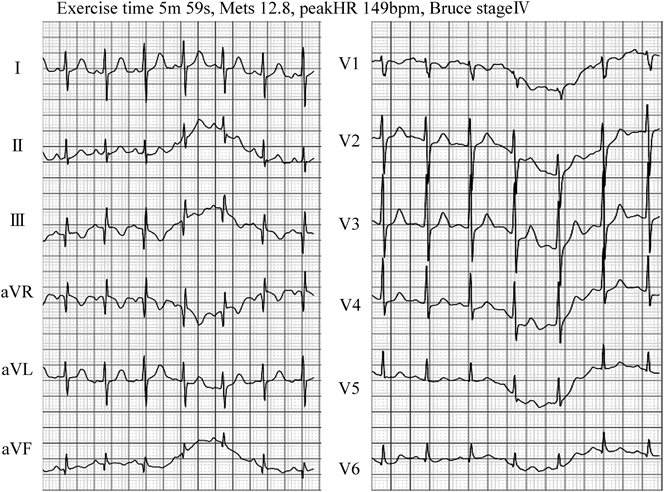 Pediatric Cardiology and Cardiac Surgery 33(1): 61-65 (2017)