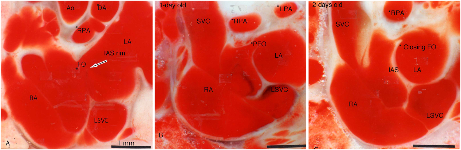 Pediatric Cardiology and Cardiac Surgery 34(4): 165-171 (2018)