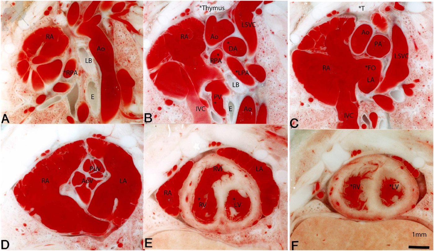 Pediatric Cardiology and Cardiac Surgery 34(4): 165-171 (2018)