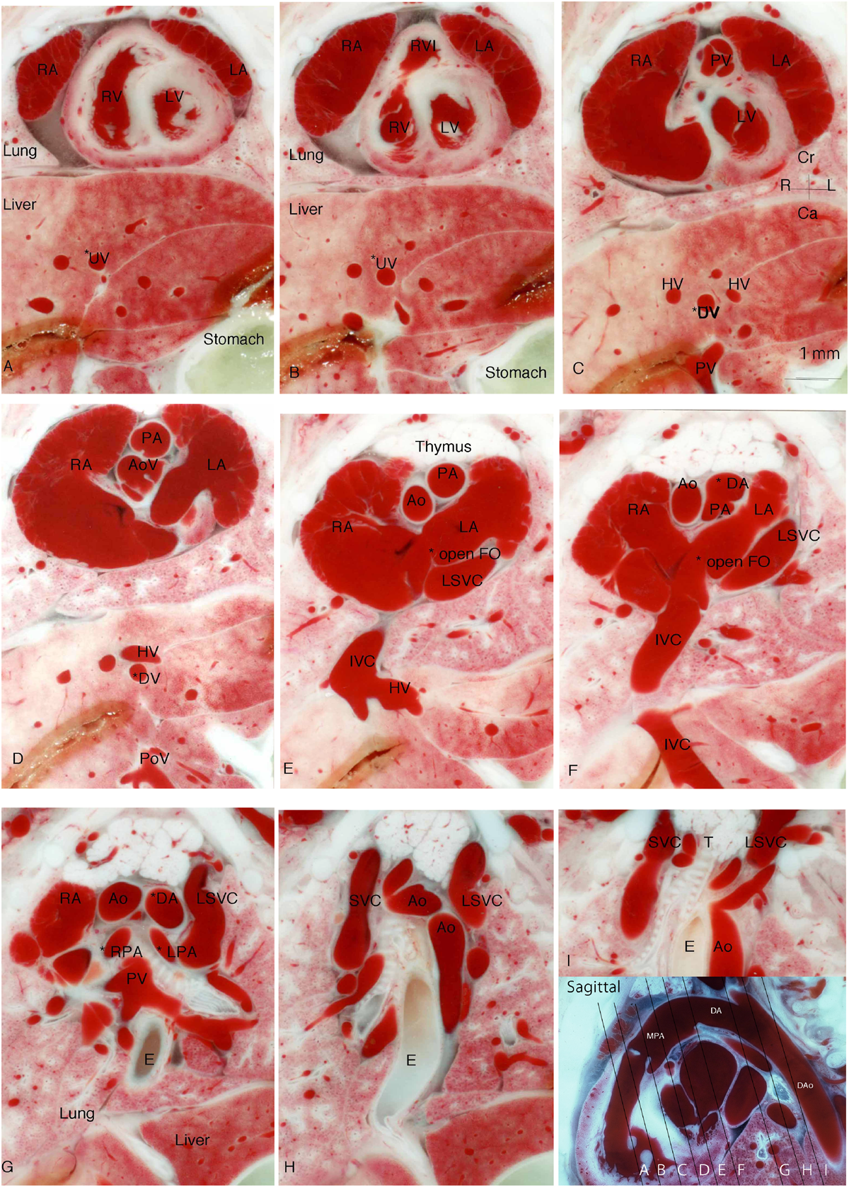 Pediatric Cardiology and Cardiac Surgery 34(4): 165-171 (2018)