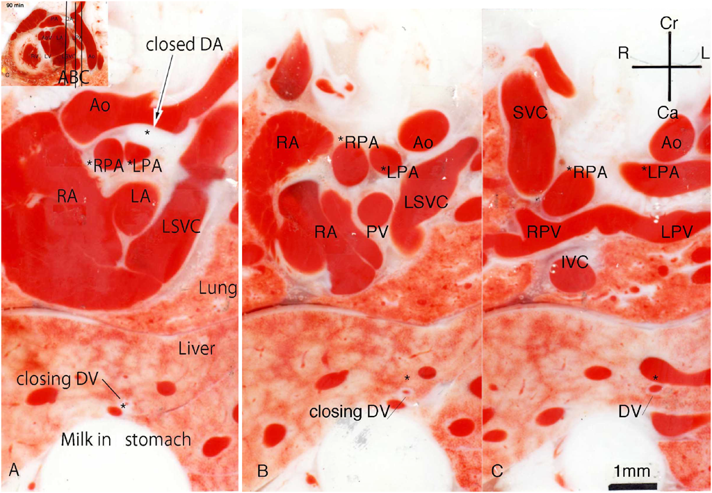 Pediatric Cardiology and Cardiac Surgery 34(4): 165-171 (2018)