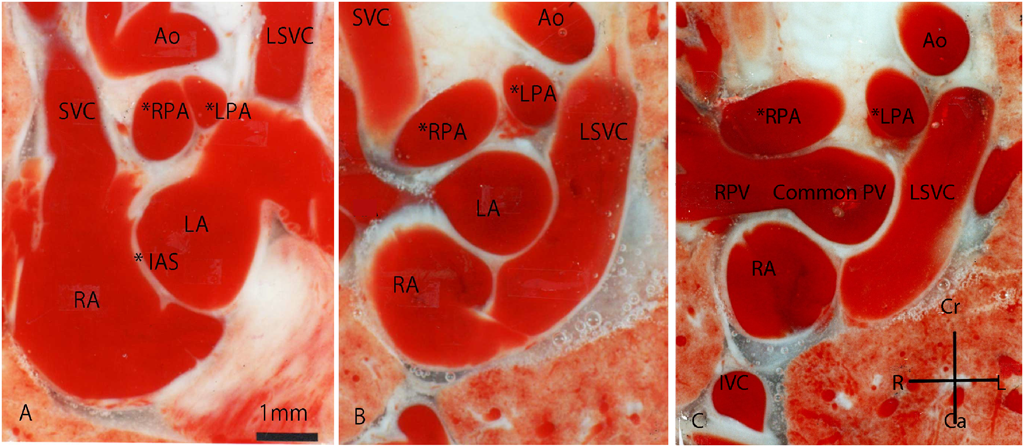 Pediatric Cardiology and Cardiac Surgery 34(4): 165-171 (2018)