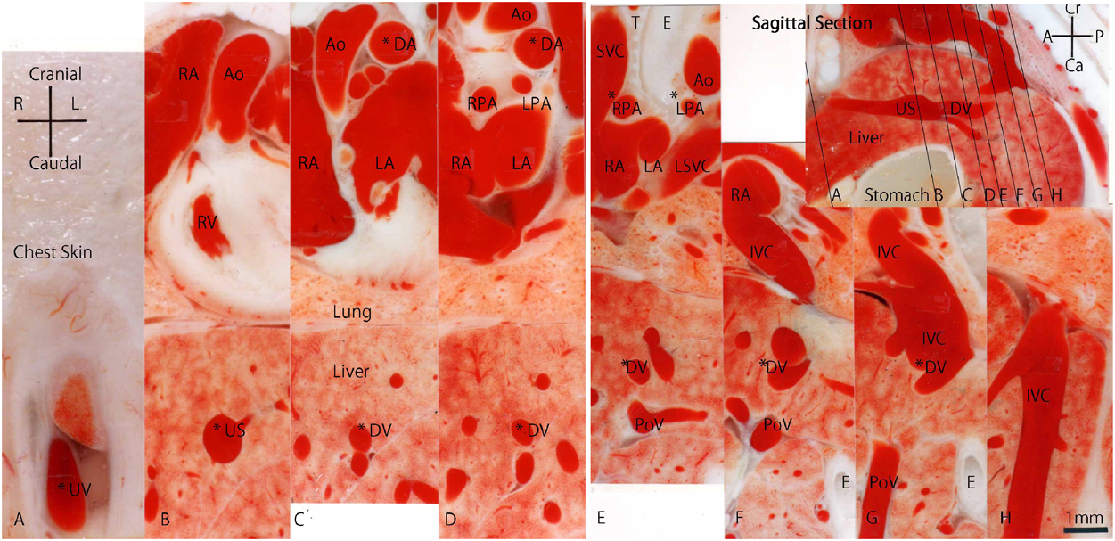 Pediatric Cardiology and Cardiac Surgery 34(4): 165-171 (2018)