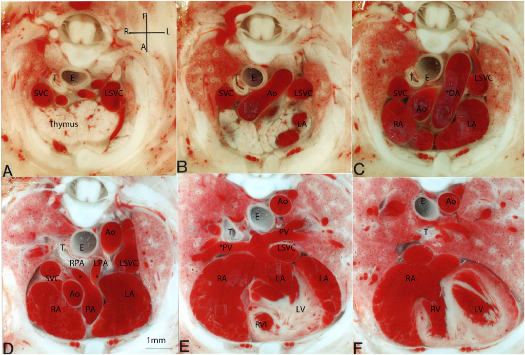 Pediatric Cardiology and Cardiac Surgery 34(4): 165-171 (2018)