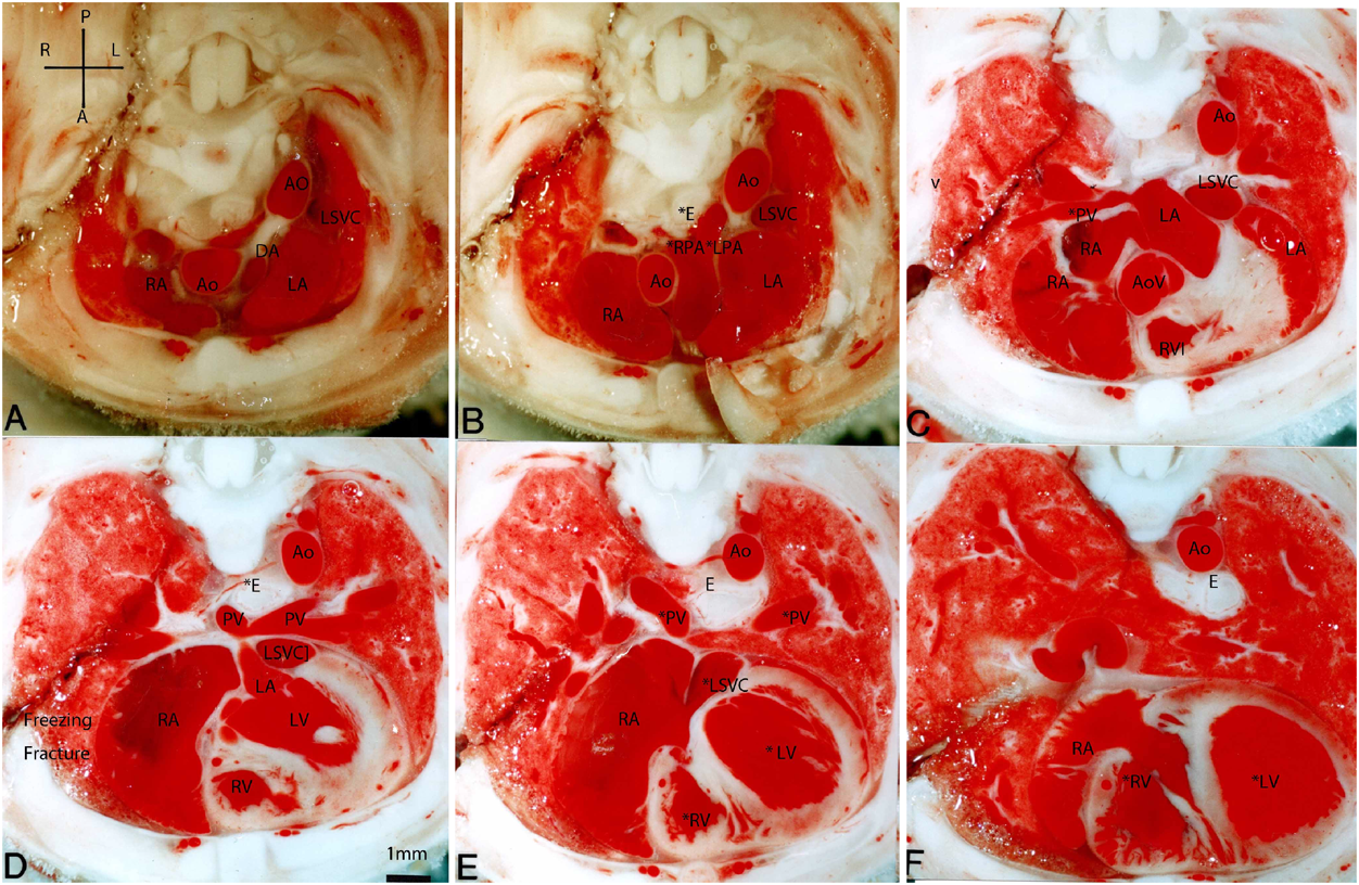 Pediatric Cardiology and Cardiac Surgery 34(4): 165-171 (2018)