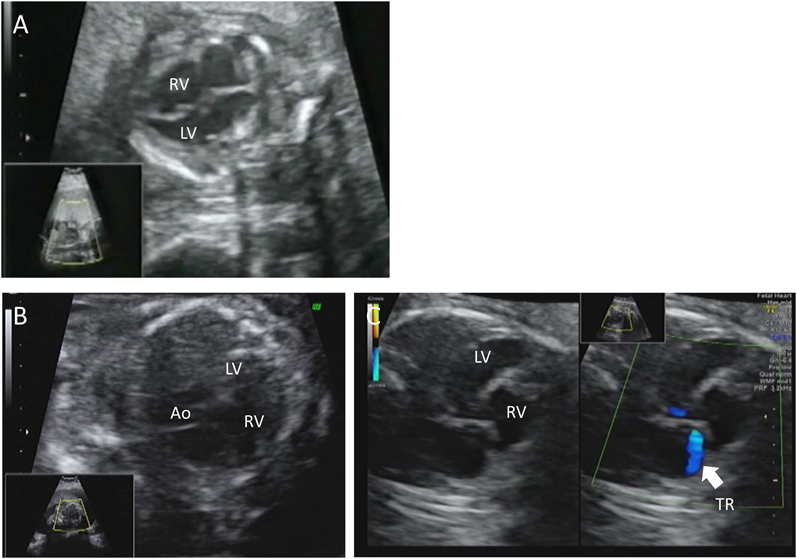 Pediatric Cardiology and Cardiac Surgery 34(1): 39-45 (2018)