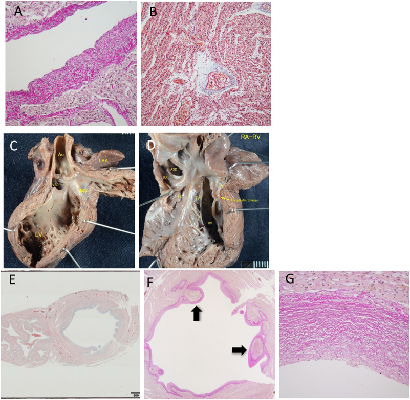 Pediatric Cardiology and Cardiac Surgery 34(1): 39-45 (2018)
