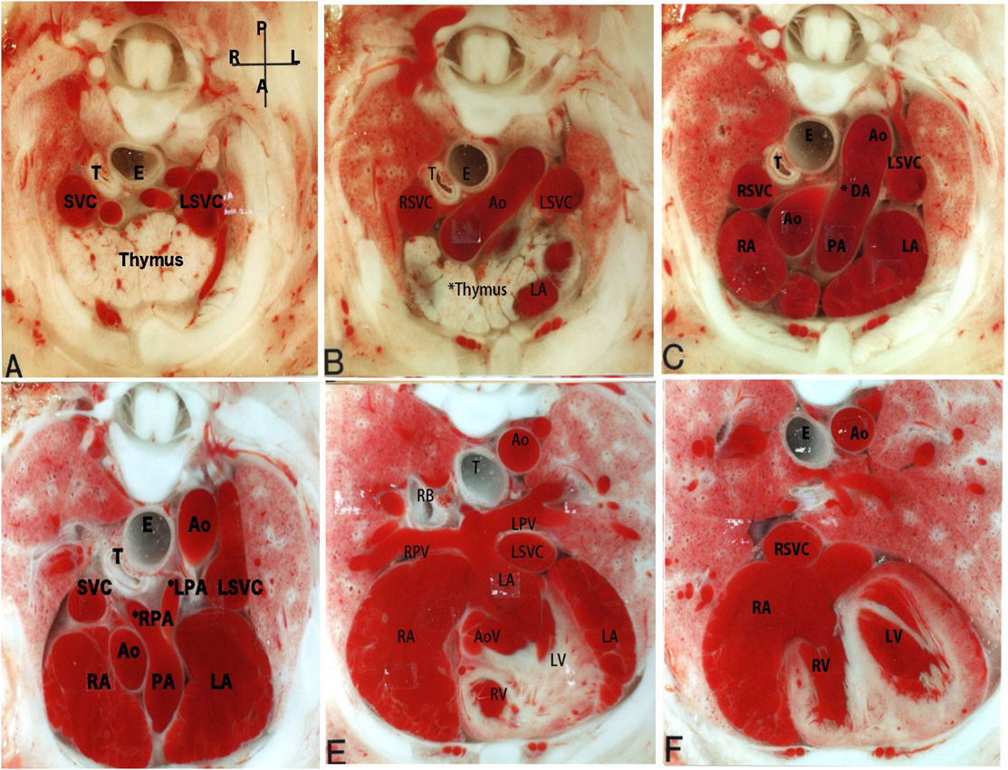 Pediatric Cardiology and Cardiac Surgery 34(2): 55-62 (2018)