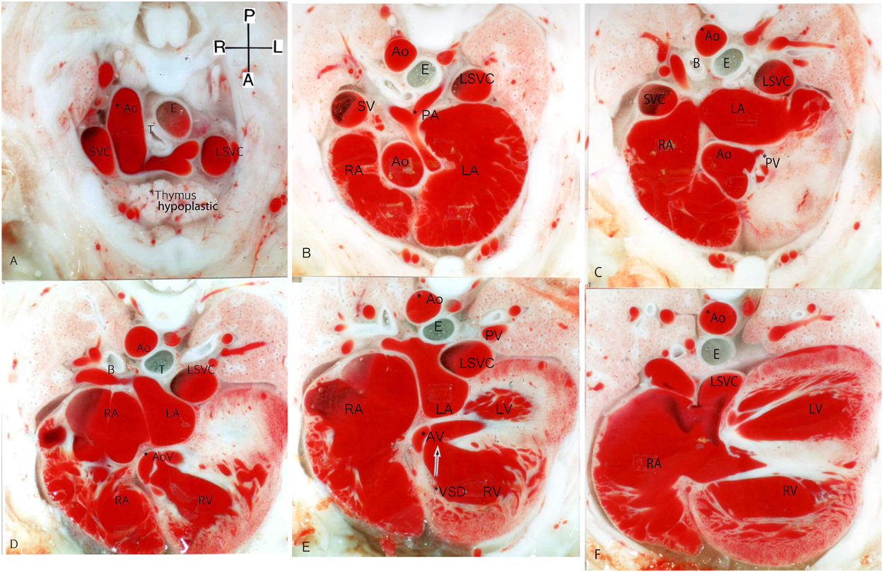 Pediatric Cardiology and Cardiac Surgery 34(2): 55-62 (2018)