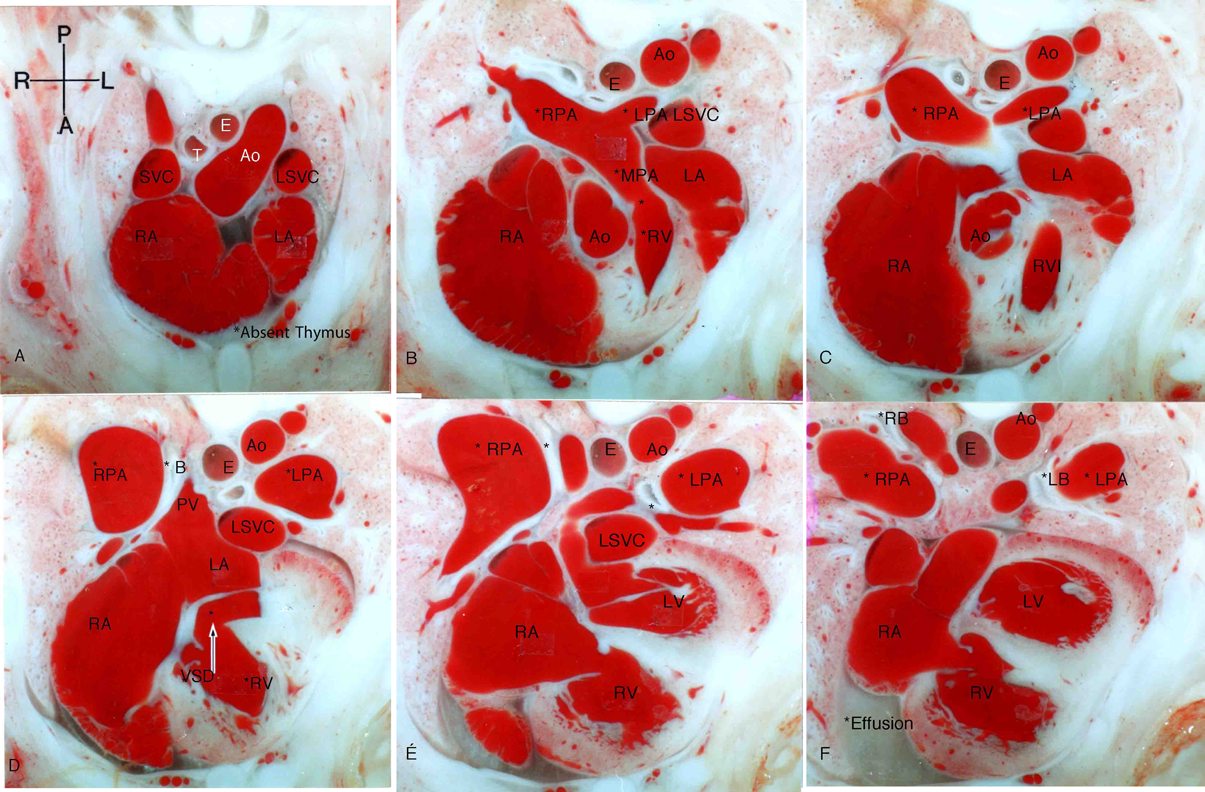 Pediatric Cardiology and Cardiac Surgery 34(2): 55-62 (2018)